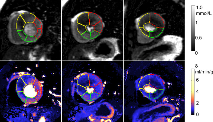 Adenosine stress perfusion images and myocardial blood flow (MBF) maps illustrate segmentation in the format of derived American Heart Association sector contours overlaid on flow maps. For each case, the first row is the images in gadolinium units and the second row is the MBF maps. Sector contours were overlaid to mark three territories for left anterior coronary artery (yellow), right coronary artery (green), and left circumflex (red). (a) Patient with single-vessel obstructive coronary artery disease in right coronary artery territory. Papillary muscle was not included in segmentation. (b) Patient with hypertrophic cardiomyopathy illustrates that the convolutional neural network–based segmentation works with thick myocardium and small cavity. The epicardial fat was correctly excluded.