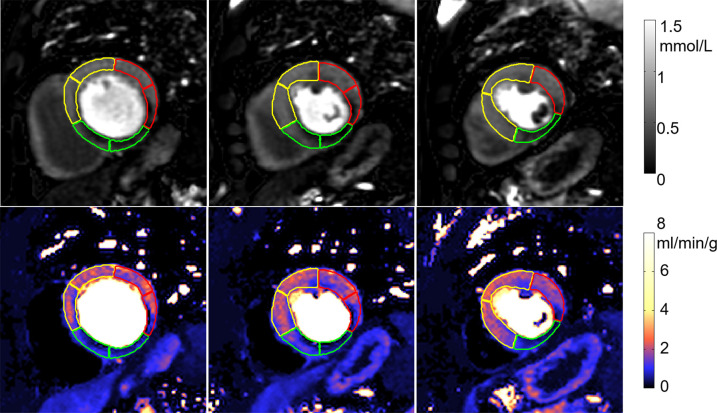 Adenosine stress perfusion images and myocardial blood flow (MBF) maps illustrate segmentation in the format of derived American Heart Association sector contours overlaid on flow maps. For each case, the first row is the images in gadolinium units and the second row is the MBF maps. Sector contours were overlaid to mark three territories for left anterior coronary artery (yellow), right coronary artery (green), and left circumflex (red). (a) Patient with single-vessel obstructive coronary artery disease in right coronary artery territory. Papillary muscle was not included in segmentation. (b) Patient with hypertrophic cardiomyopathy illustrates that the convolutional neural network–based segmentation works with thick myocardium and small cavity. The epicardial fat was correctly excluded.