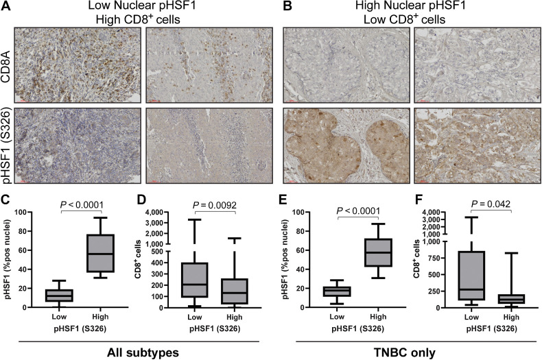 Figure 5. Active HSF1 in breast cancer tumor specimens coincides with low CD8+ T cells. A and B, A cohort of 114 breast tumors were subjected to IHC with antibodies for CD8A and pHSF1 (S326). C and D, All patients (n = 114) were separated into high (n = 46) or low (n = 68) HSF1-active tumors based on nuclear positivity percentage for pHSF1 (C) and CD8+ (D) cells were compared between these two groups based on active HSF1 levels using a Student t test. E and F, Only patients with TNBC; n = 38) were separated into high (n = 21) or low (n = 17) HSF1-active tumors based on nuclear positivity percentage for pHSF1 (E) and CD8+ (F) cells were compared between these two groups based on active HSF1 levels using a Student t test.