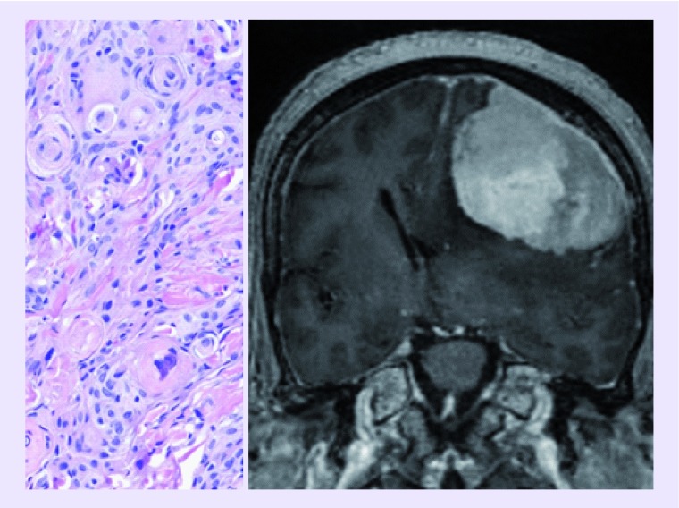 An overview of meningiomas - PMC