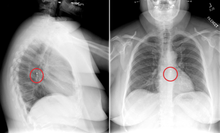 Acute Chest Pain Following Bravo Device Placement - PMC