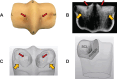 Segmentation of the sclerotic and lytic regions.