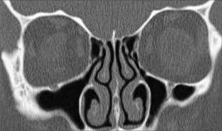 An Analysis of the Anatomic Variations of the Paranasal Sinuses and ...