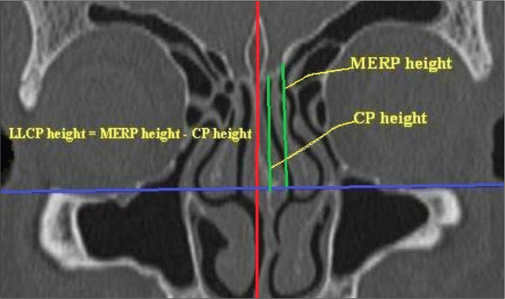 An Analysis of the Anatomic Variations of the Paranasal Sinuses and ...