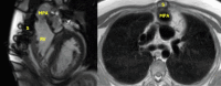 CMR shows RV and main pulmonary artery adhesions to the sternum in patient after biventricular repair with arterial switch