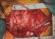 Patient needing PA reconstruction with patch for landing zone for donor PAs