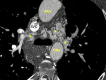 Chest CTA shows extensive collateral networks around airway, SVC and aorta in patient with unbalanced complete AV canal after Fontan palliation