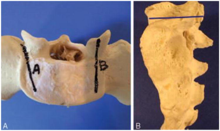 Biomechanical Analysis of an S1 Pedicle Screw Salvage Technique via a ...