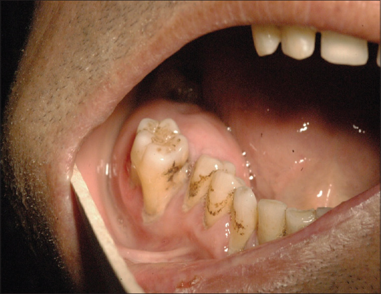 Odontogenic myxoma with pain and uncommon histological feature in the ...