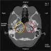CT demonstrates absent carotid canal at base of skull on left