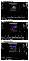 (A) Right common carotid artery (CCA); (B) left CCA; (C) left internal carotid