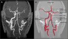 Absent left ICA with good cross-filling via contralateral anterior cerebral artery
