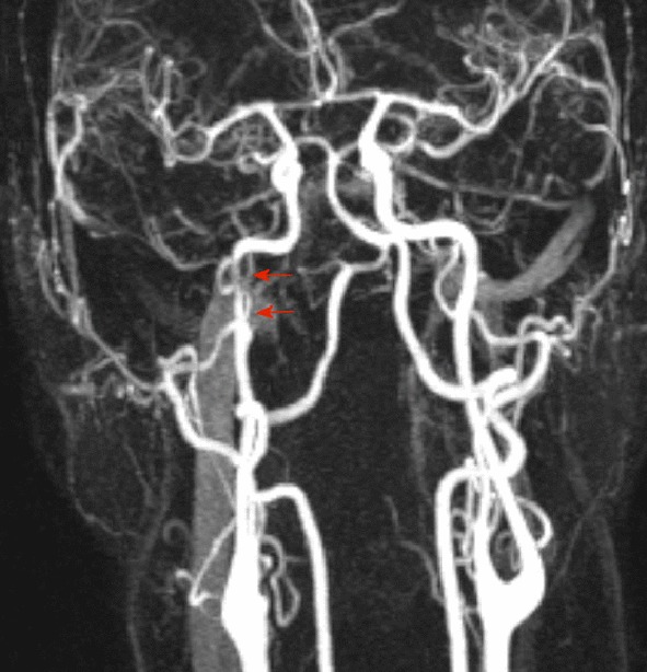 Carotid dissection presenting as a prolonged cluster-like headache in a ...