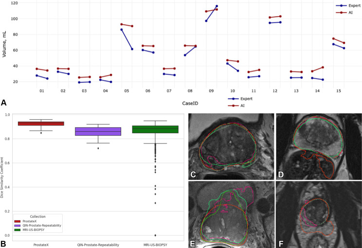 Highlights of an ongoing study evaluating the nnU-Net (42) and Prostate158 (47) algorithms applied to the prostate gland segmentation task. (A) Graph shows a comparison of the prostate gland volume calculated from the segmentation produced by AI (red) and the expert (blue) on the QIN-Prostate-Repeatability collection (50) available in IDC. Two measurements corresponding to the same case identification number were derived from the segmentations obtained from the two imaging studies obtained within 2 weeks, precluding biologic changes in the anatomy. Prostate volume is in most cases overestimated by AI as compared with the expert segmentations. (B) Dice similarity coefficient (DSC) graph shows that the distributions are visually different across the PROSTATEx, QIN-Prostate-Repeatability, and MRI-US-Biopsy collections of IDC. (C–F) Sample MR images from the PROSTATEx (C, D), QIN-Prostate-Repeatability (E), and MRI-US-Biopsy (F) collections show segmentation results produced by different AI algorithms and the manual outlines of the prostate (dark green).