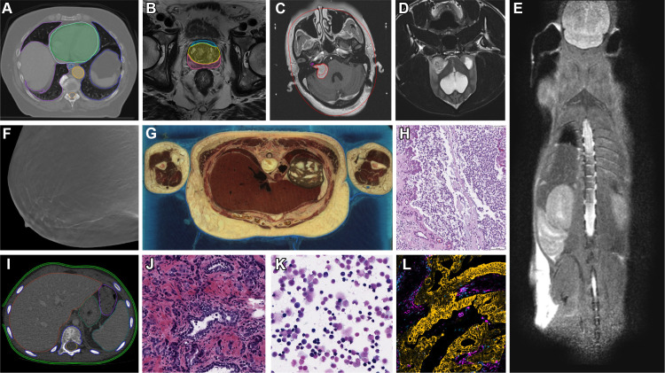 Representative images and image annotations available in IDC. (A) NSCLC-Radiomics (22) CT image shows lung cancer with manually annotated regions of interest and nnU-Net-BPR-Annotations (23) (AI-annotated regions of interest). NSCLC = non–small cell lung cancer. (B) PROSTATEx (24) MR image shows PROSTATEx-Seg-Zones (25), expert-annotated prostate anatomy zones. Seg = segmentation. (C) Vestibular-Schwannoma-SEG (26) MR image shows schwannoma with manually annotated regions of interest. (D) ICDC-Glioma (27) MR image shows canine glioma. ICDC = Integrated Canine Data Commons. (E) PDMR-997537-175-T MR image shows a mouse adenocarcinoma colon xenograft. PDMR = Patient-Derived Models Repository. (F) Breast-Cancer-Screening-DBT (28) tomosynthesis image. DBT = digital breast tomosynthesis. (G) NLM-Visible-Human-Project (20) cryomacrotome anatomic image. (H) ICDC-Glioma (27) canine hematoxylin and eosin (H-E) stain digital pathology photomicrograph. (I) Pediatric-CT-SEG (29) pediatric CT image with expert-annotated organ contours. (J) TCGA-PRAD (5) H-E stain digital pathology photomicrograph shows prostate cancer. TCGA-PRAD = The Cancer Genome Atlas Prostate Adenocarcinoma. (K) CPTAC-AML (6) H-E stain digital pathology photomicrograph shows acute myeloid leukemia. CPTAC-AML = Clinical Proteomic Tumor Analysis Consortium Acute Myeloid Leukemia. (L) HTAN-HMS (7) multichannel fluorescence image with pan-cytokeratin, CD45, vimentin, and Ki67 channels selected. HTAN = Human Tumor Atlas Network.