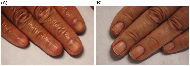 Optimal diagnosis and management of common nail disorders - PMC