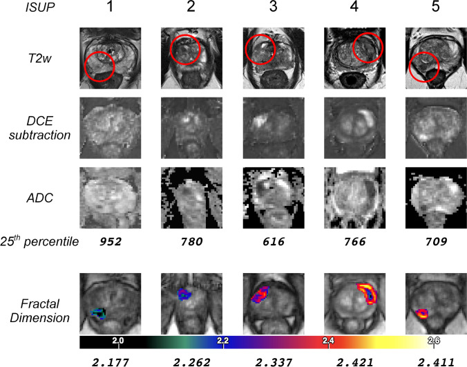 Accuracy Of Fractal Analysis And Pi-rads Assessment Of Prostate 