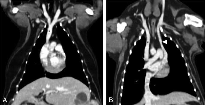 Imaging characteristics of persistent left cranial vena cava ...