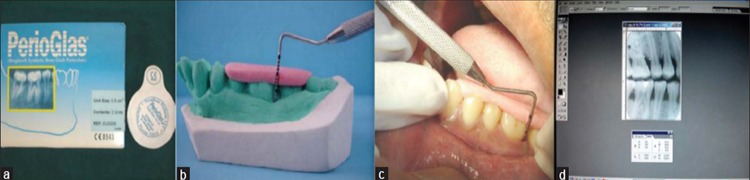 Figure 1: (a) Perioglas bone graft. (b) Acrylic stent on
cast. (c) Pocket probing with UNC-15 probe. (d) Radiographic
measurements using Adope photoshop.