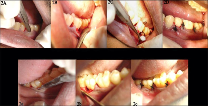 Figure 2: (A-D) Clinical pictures of the experimental site.
(a-c) Clinical pictures of control cite.