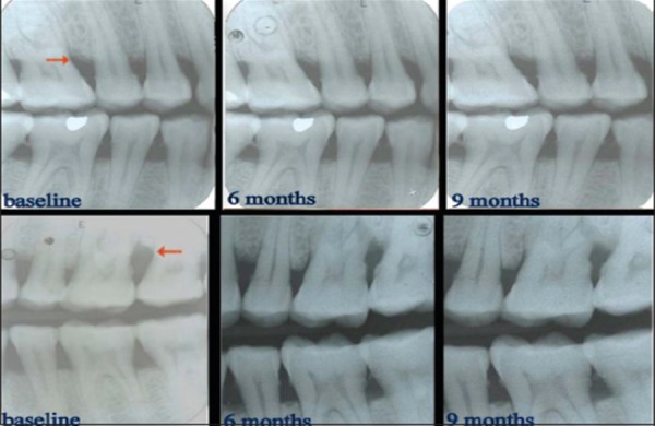 Figure 3: Radiographs of control site and experimental site.