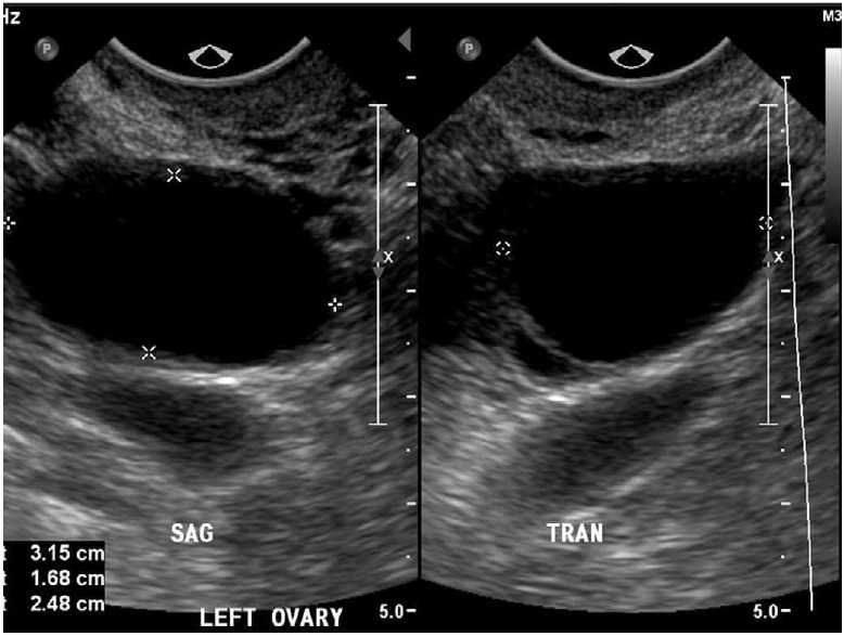 Ultrasonography of adnexal causes of acute pelvic pain in pre ...