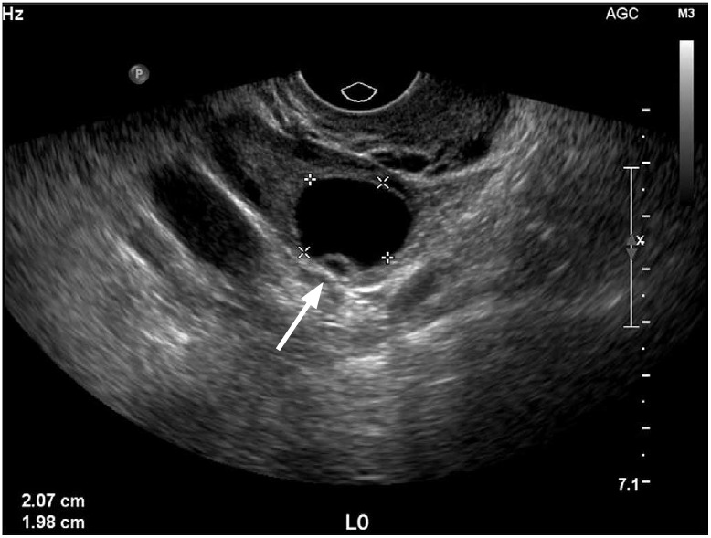 Ultrasonography of adnexal causes of acute pelvic pain in pre ...