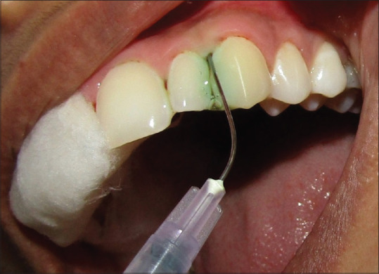 Comparative Evaluation Of The Effect Of Ozone Therapy And Photodynamic 