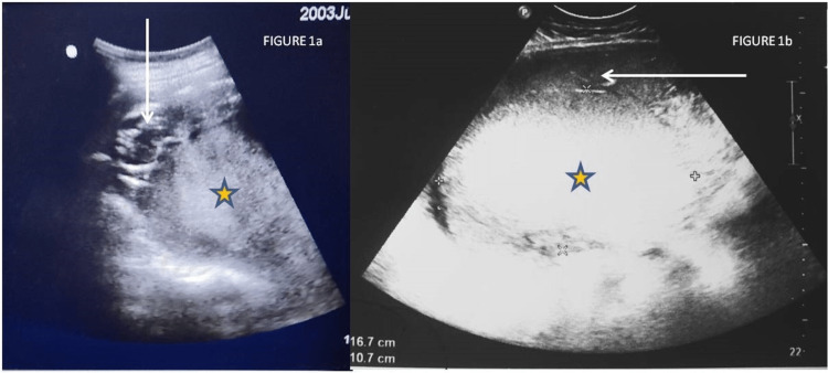 Chronic Abruptio Placentae With Multiple Alloantibodies: An ...