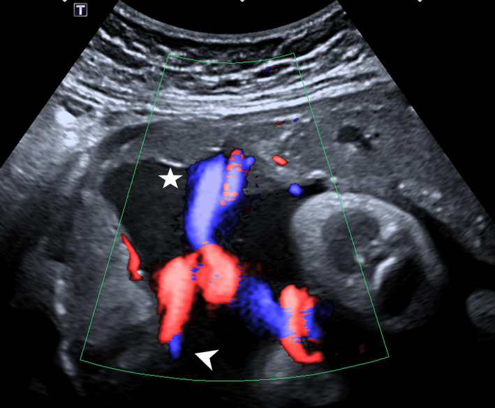 Furcate umbilical cord insertion with a bilobed placenta identified on ...