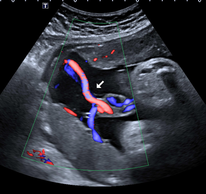 Furcate umbilical cord insertion with a bilobed placenta identified on ...