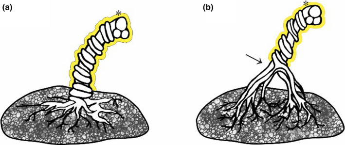 Furcate umbilical cord insertion with a bilobed placenta identified on ...