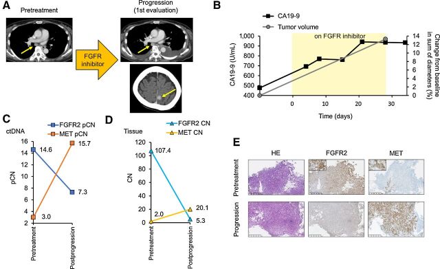 Figure 4. Clinical presentation. A, Tumor evaluation by CT at pretreatment and progression on an FGFR inhibitor with progressive lymph node enlargement and the emergence of a new brain metastasis (yellow arrows) in patient 3. B, Changes in CA 19-9 and sum of diameters of target lesions by CT following treatment with an FGFR inhibitor. C, Change in the ctDNA pCN of FGFR2 and MET amplification before treatment and at progression on an FGFR inhibitor. D, Change in the tissue CN of FGFR2 and MET amplification before treatment and at progression on FGFR inhibitor. E, Hematoxylin and eosin–stained and IHC-stained images with anti-FGFR2 and MET antibodies of biopsy specimens of the primary gastric cancer before treatment and at progression on an FGFR inhibitor.