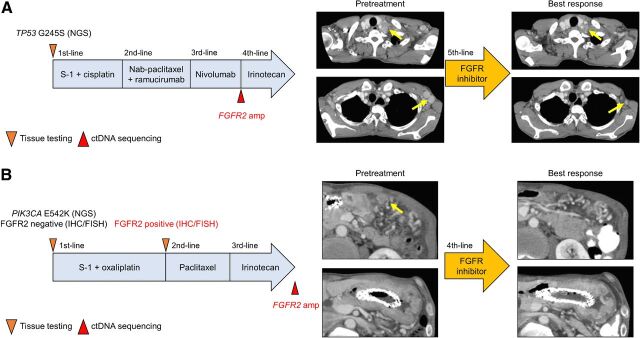 Figure 3. Treatment history and tumor evaluation by CT before treatment and best response in patients with FGFR2 amplification detected only by ctDNA who had tumor responses to FGFR inhibition with the shrinkage of target lesions (yellow arrows). A, Patient 1. B, Patient 2.