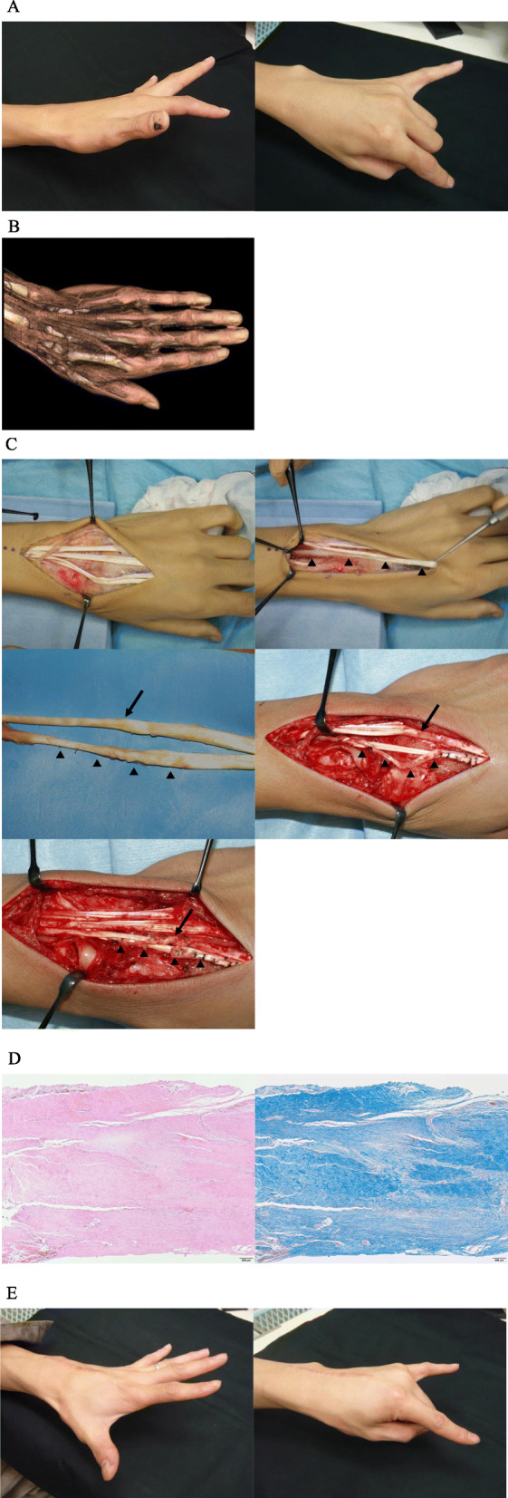 Traumatic index extensor tendon attenuation mimicking closed tendon ...