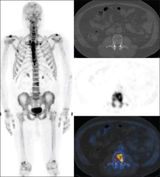 Prostate-specific Antigen Cutoff Value For Ordering Sodium Fluoride 