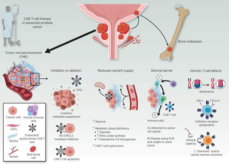 Figure 2. Immunosuppressive barriers to CAR T-cell function in advanced (metastatic) prostate cancer. Recent studies, including those discussed in this review, suggest that both tumor- and T-cell–intrinsic factors could hamper the efficacy of CAR T cells in prostate cancer. Barriers include elaboration of immunosuppressive cytokines (e.g., TGFβ), increased expression of inhibitory ligands (e.g., PD-L1), apoptosis of CAR T cells, and metabolic stress operative in the TME. A formidable stromal barrier may result in CAR T-cell and bystander immune cell migration along the protumor extracellular matrix (ECM), instead of infiltration into the tumor bed. T cell–intrinsic defects, including replicative senescence, inhibitory receptor upregulation/exhaustion, and reduced early memory T-cell function, may also prevent CAR T cells from eliciting an effective antitumor response.