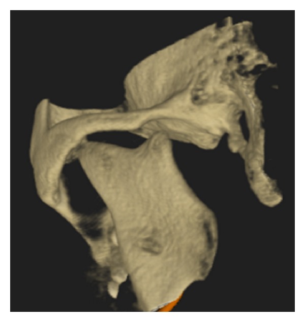 Condylar Aplasia and Hypoplasia: A Rare Case - PMC