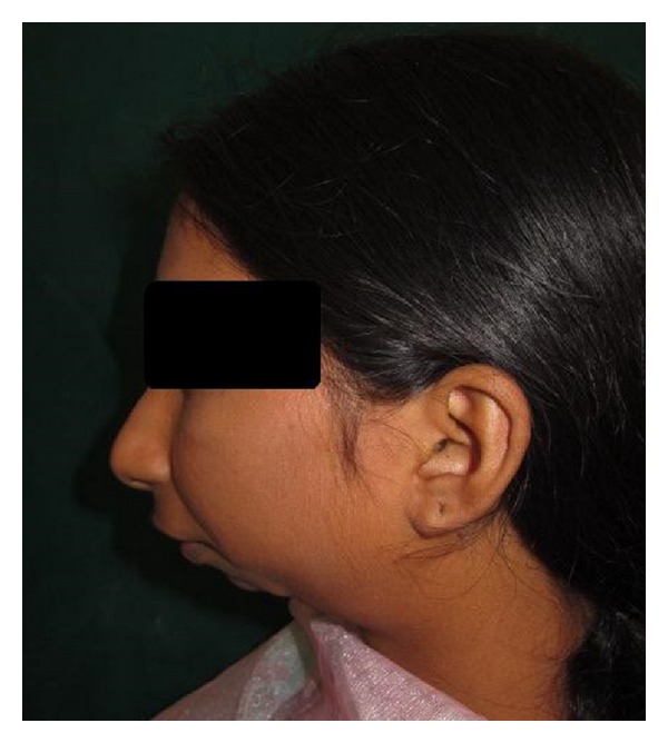 Condylar Aplasia and Hypoplasia: A Rare Case - PMC