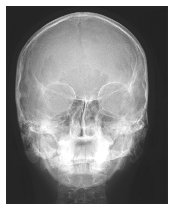 Condylar Aplasia and Hypoplasia: A Rare Case - PMC