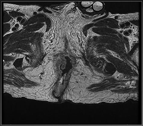 Perianal Basal Cell Carcinoma: A Common Cancer In An Uncommon Location ...