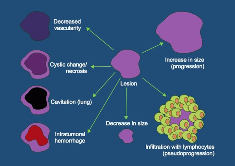 F 18 fluciclovine pet ct findings and pseudoprogression on