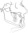 Figure 1. Class III group. Representative superimposition of T0 (before treatment, black lines) to T1 (end of the two-phase treatment, dark grey lines) to T2 (an average of 10 years after treatment, light grey lines).