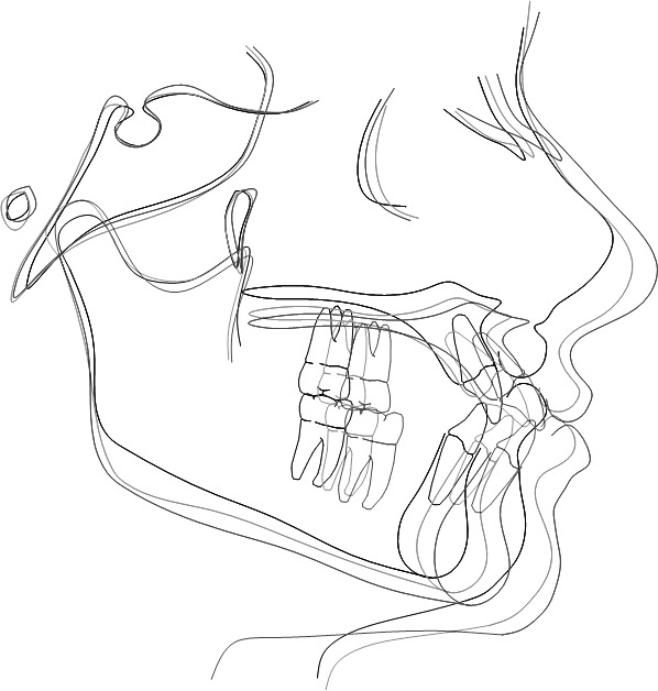 Figure 2. Control group. Representative superimposition of T0 (before treatment, black lines) to T1 (end of the 2-phase treatment, dark grey lines) to T2 (an average of 10 years after treatment, light grey lines).