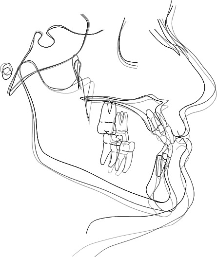 Figure 1. Class III group. Representative superimposition of T0 (before treatment, black lines) to T1 (end of the two-phase treatment, dark grey lines) to T2 (an average of 10 years after treatment, light grey lines).