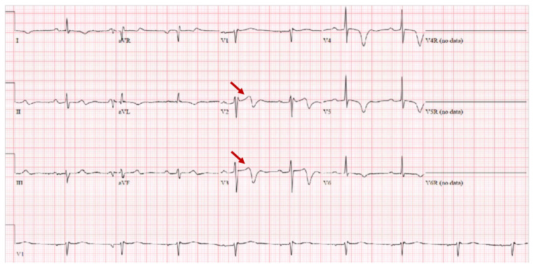 A Classic Pattern of Wellens Syndrome on ECG: A Case Report - PMC