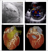 Coronary angiogram, TTE, and CCTA showing ALCAPA with collateral vessels pre- and post-surgical repair