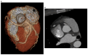 Two CCTA images of AAOCA-R with slit-like ostium and intramural course
