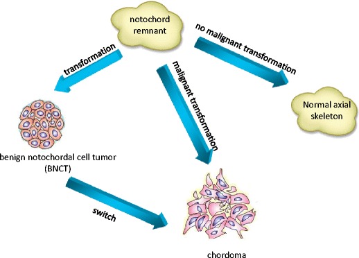 Chordoma: an update on the pathophysiology and molecular mechanisms - PMC