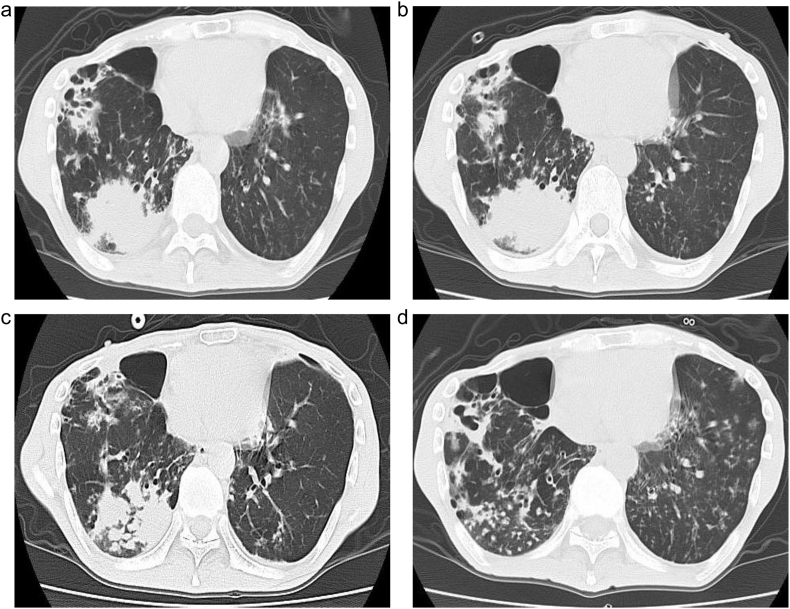 Successful use of linezolid for refractory mycobacterium abcessus